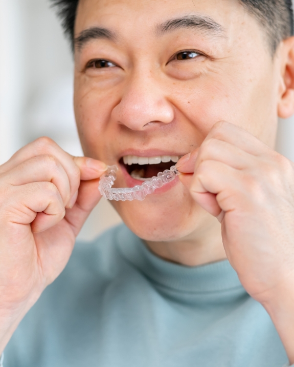 Man placing a clear aligner over his teeth