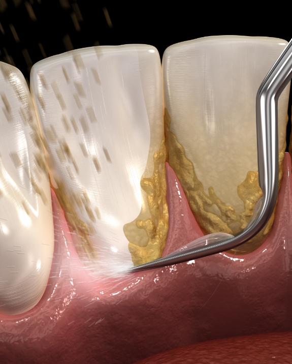 Illustrated dental scaler removing plaque from teeth during gum disease treatment