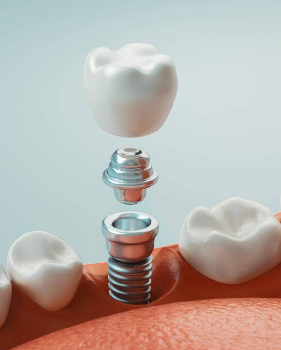 Illustrated model of a dental implant in Mesa