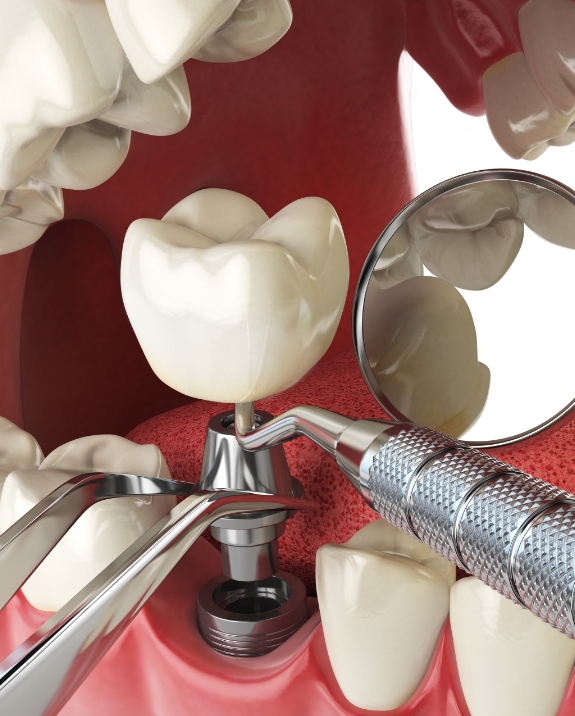 Illustrated dental implant being placed in the lower jaw