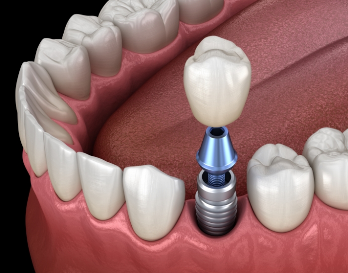 Illustrated dental crown being placed onto a dental implant