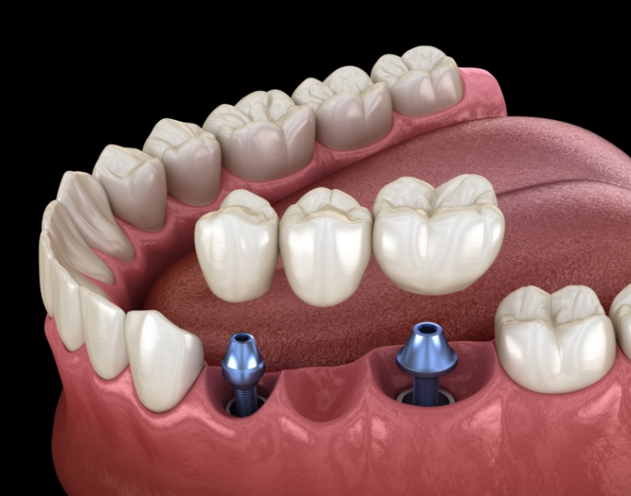 Illustrated dental bridge being placed onto two dental implants