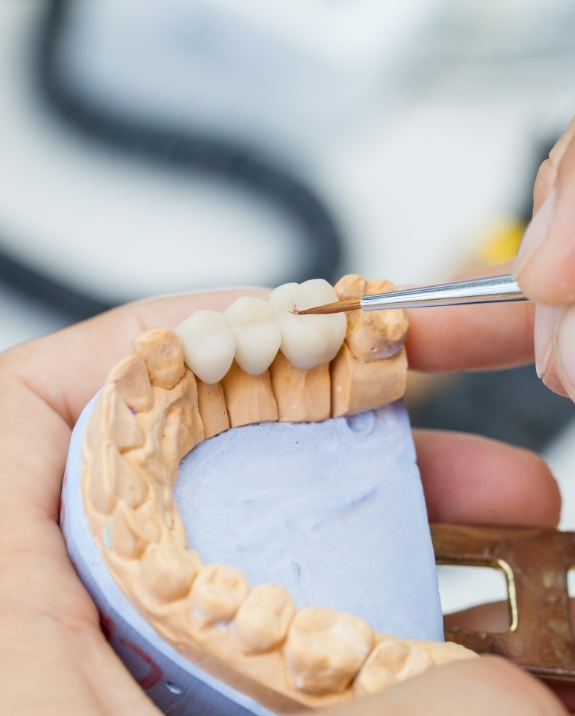 Dental ceramist designing a dental bridge to replace missing teeth
