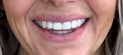 Close up of smiling woman with well aligned teeth