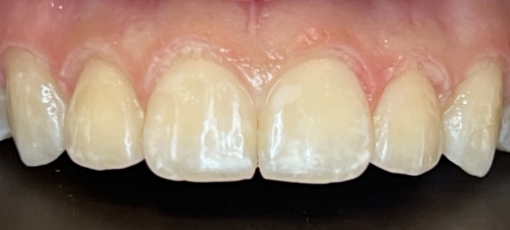 Close up of upper arch after gummy smile correction