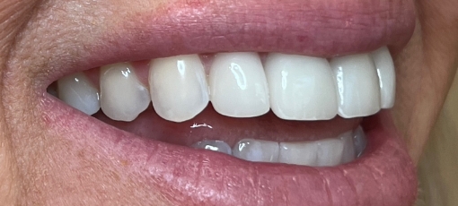Close up of whiter and better aligned teeth