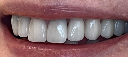 Row of whiter and more evenly spaced teeth