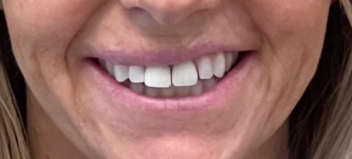 Close up of smiling woman with misaligned teeth