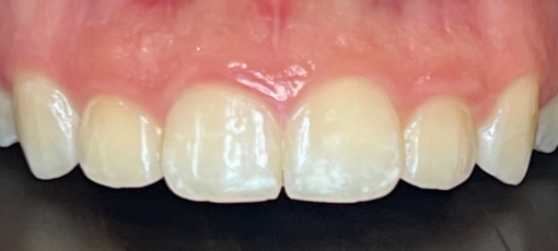 Close up of upper arch of teeth in gummy smile