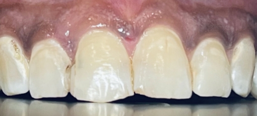 Close up of row of damaged teeth
