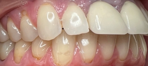 Close up of slightly yellow and misaligned teeth