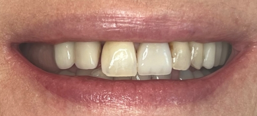 Row of slightly gapped and yellowed teeth