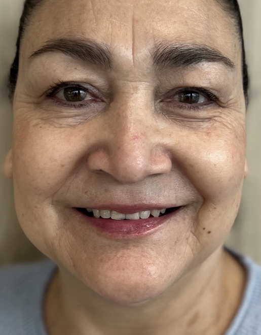 Woman smiling with slightly stained teeth