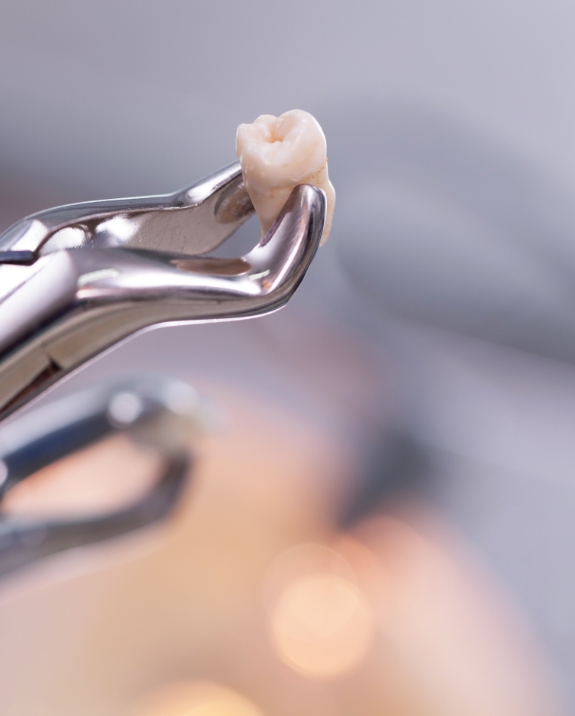 Dental forceps holding an extracted tooth