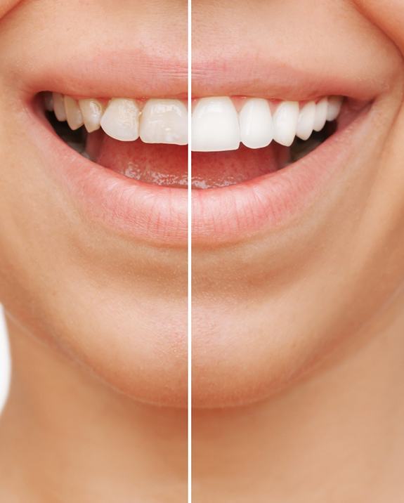 Patient's smile before and after veneers