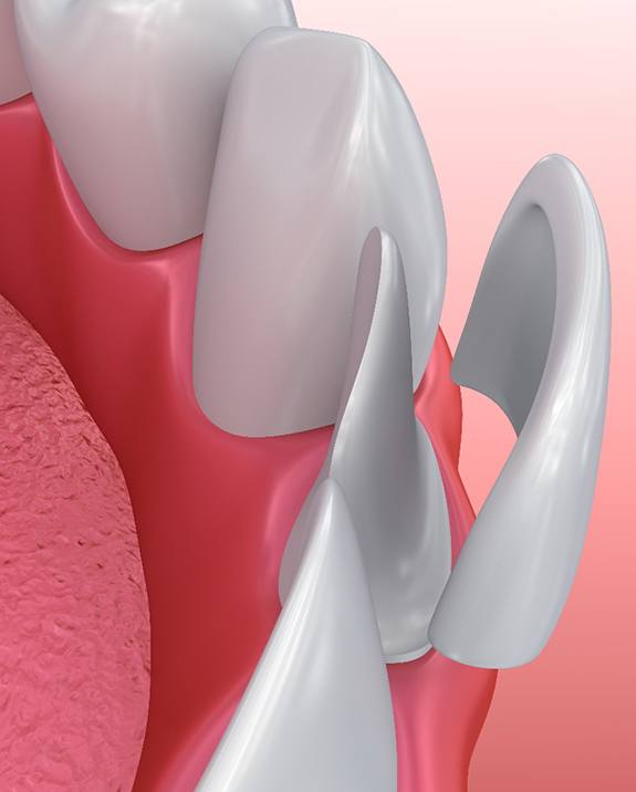 Illustration of veneer being placed on lower tooth