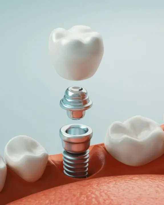 dental installation