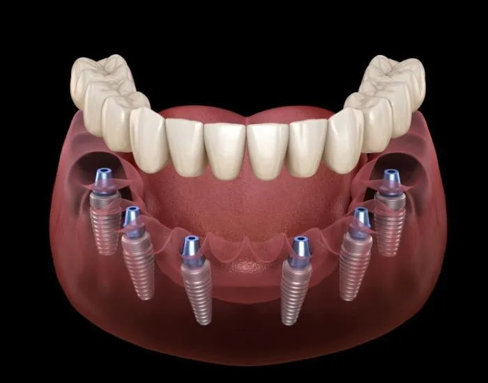 Single tooth implant
