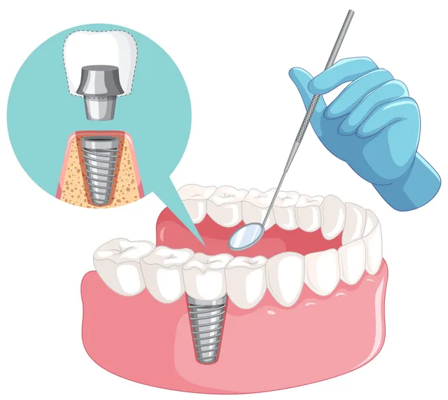 Dental implant illustration: tooth with a metal post in the jaw, a dentist's tool in the mouth.